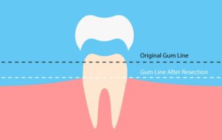 dental-surgeons-implant-center-crown_lengthening-30bj6xzcuj6et9a3zy4ef4
