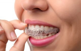 speed-up-invisalign