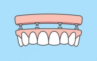 All-on-four-illustration