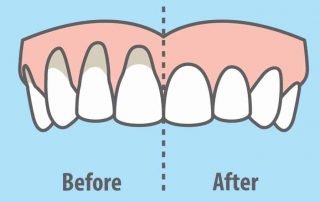 heal-receding-gums