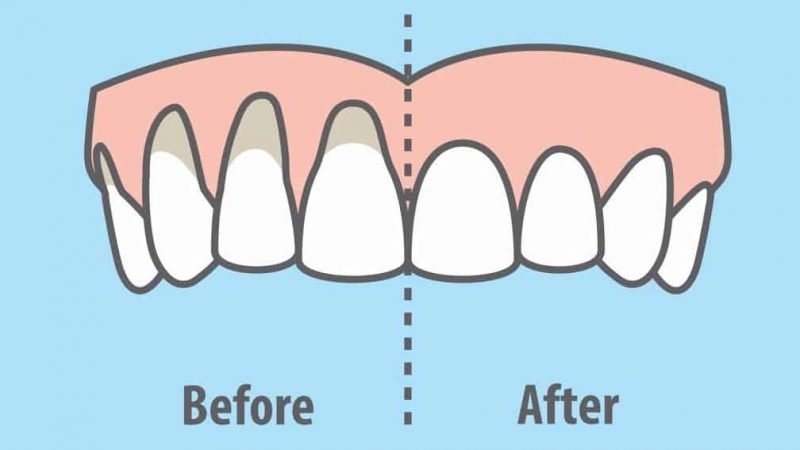 heal-receding-gums