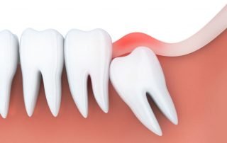 wisdom-tooth-825x550