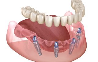 Mandibular prosthesis All on 4 system supported by implants. Medically accurate 3D illustration of human teeth and dentures concept