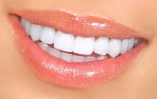 dental veneers