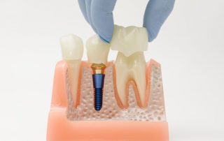 dental-restoration-1068x740