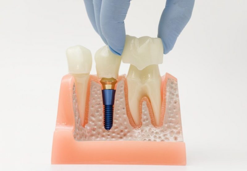 dental-restoration-1068x740