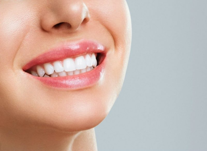 teeth-whitening-1068x777
