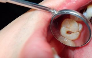 cavity-untreated-1068x744