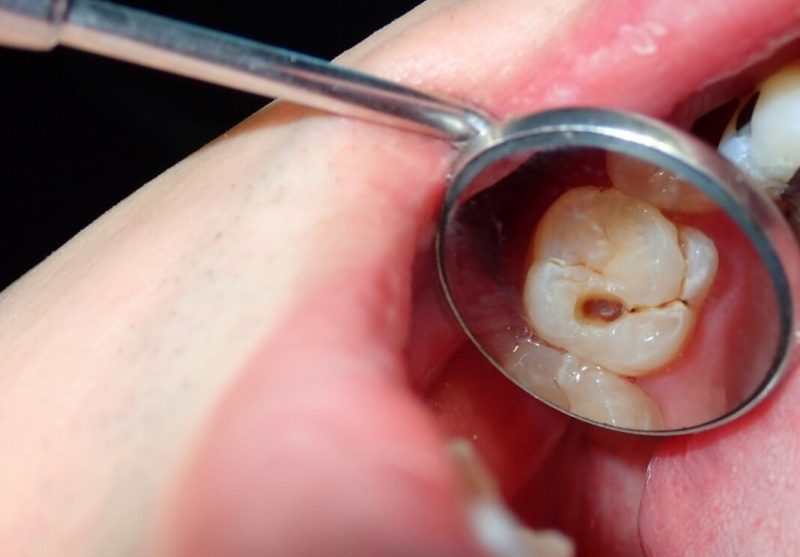 cavity-untreated-1068x744